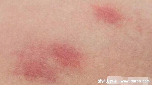 血毒血熱引起皮膚病圖片，引發各種疹子/毛囊炎/紅斑狼瘡/牛皮癬