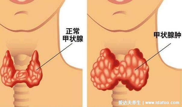 女性甲狀腺的前兆圖片，甲減會導致容貌異常還影響生育