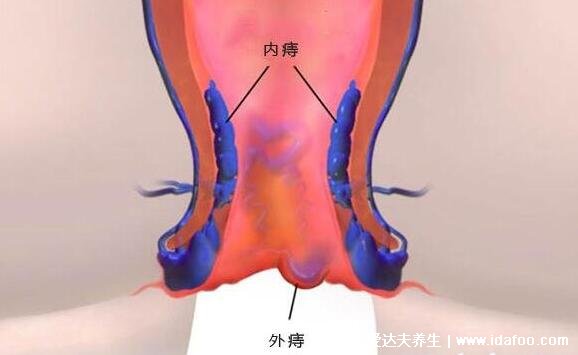 痔瘡長什么樣子的圖片，真實的輕微痔瘡圖片大全