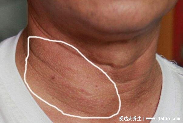 女性甲狀腺的前兆圖片，甲減會導致容貌異常還影響生育