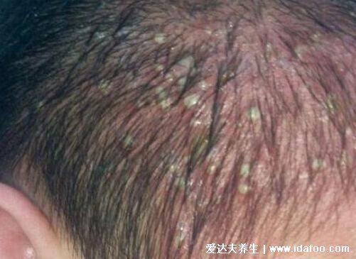 血毒血熱引起皮膚病圖片，引發各種疹子/毛囊炎/紅斑狼瘡/牛皮癬