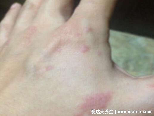 血毒血熱引起皮膚病圖片，引發各種疹子/毛囊炎/紅斑狼瘡/牛皮癬