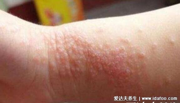 血毒血熱引起皮膚病圖片，引發各種疹子/毛囊炎/紅斑狼瘡/牛皮癬