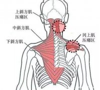 背部筋膜炎疼痛位置圖，身體背部各部位疼痛對比圖。