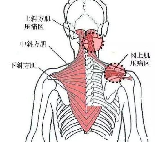 背部筋膜炎疼痛位置圖，身體背部各部位疼痛對比圖