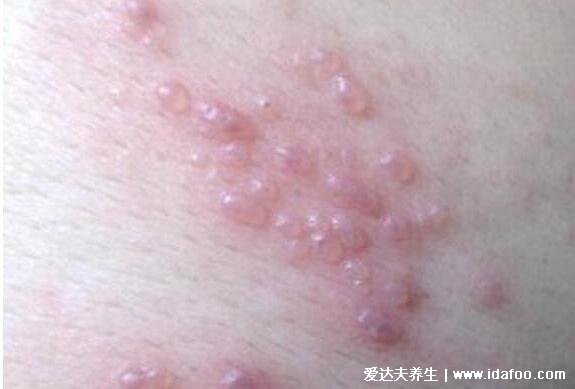 血毒血熱引起皮膚病圖片，引發各種疹子/毛囊炎/紅斑狼瘡/牛皮癬