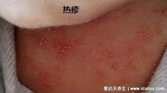 血毒血熱引起皮膚病圖片，引發各種疹子/毛囊炎/紅斑狼瘡/牛皮癬
