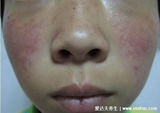 血毒血熱引起皮膚病圖片，引發各種疹子/毛囊炎/紅斑狼瘡/牛皮癬