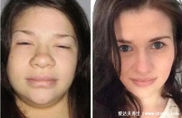 女性甲狀腺的前兆圖片，甲減會導致容貌異常還影響生育