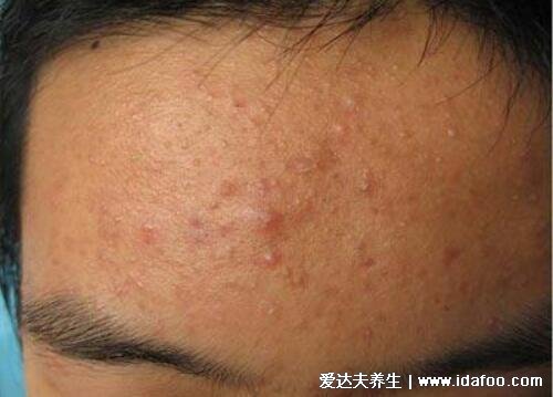 血毒血熱引起皮膚病圖片，引發各種疹子/毛囊炎/紅斑狼瘡/牛皮癬