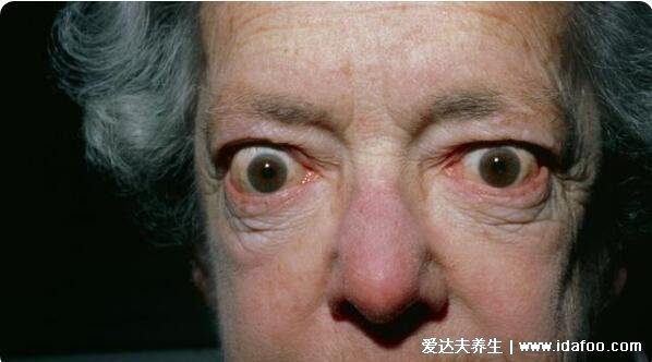 女性甲狀腺的前兆圖片，甲減會導致容貌異常還影響生育
