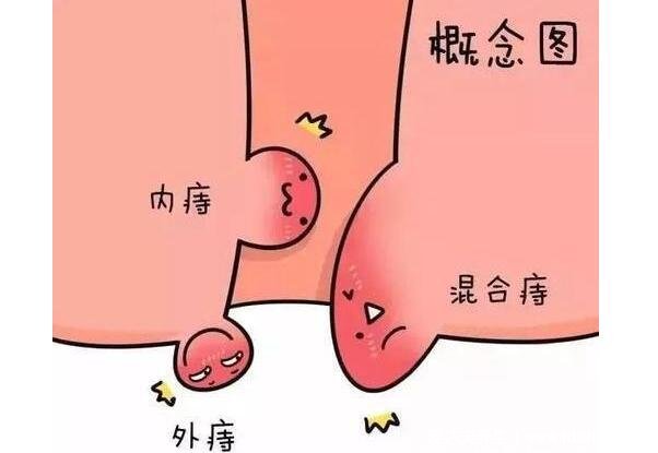 痔瘡長什么樣子的圖片，真實的輕微痔瘡圖片大全