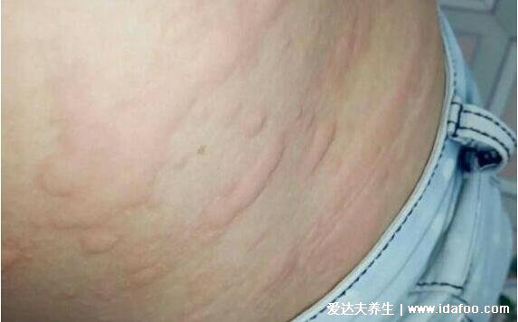 血毒血熱引起皮膚病圖片，引發各種疹子/毛囊炎/紅斑狼瘡/牛皮癬