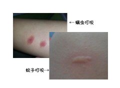 床螨叮咬的癥狀圖片，像晚上比白天癢的蚊子(螨蟲最怕這三樣東西)