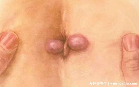怎么判斷自己是不是長了痔瘡，真實的輕微痔瘡圖片大全