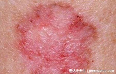 皮膚病圖片對照大全查看圖片，包含100種疾病的癥狀圖自測