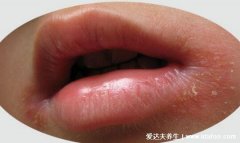 嘴角長皰疹口腔潰瘍(口唇皰疹和口角炎的