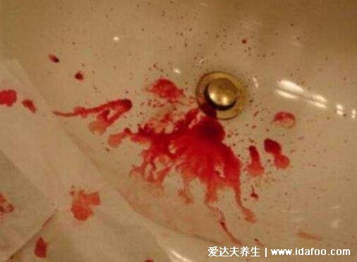 肺癌晚期最怕三個征兆，劇烈疼痛/潰爛/出血(早中晚期出血特點) 