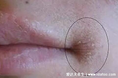 初期口角炎圖片及癥狀，嘴角起皰會糜爛結痂(3種類型附醫治法)