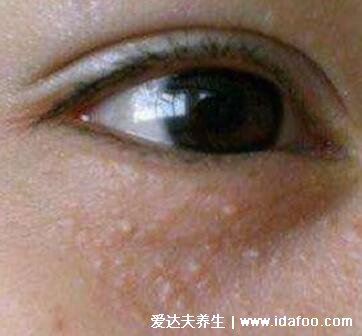 眼部扁平疣圖片及去除方法，不痛不癢有傳染性的粉色疙瘩