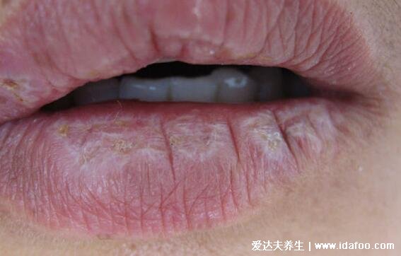 扁平苔蘚圖片癥狀，口腔長白斑/皮膚上有紫紅色扁平丘疹