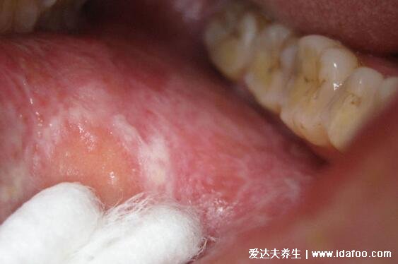 扁平苔蘚圖片癥狀，口腔長白斑/皮膚上有紫紅色扁平丘疹