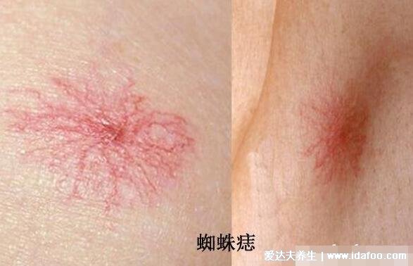 真實的肝掌圖片高清圖片，肝掌/蜘蛛痣可能是嚴重肝病的前兆