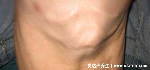 嬰兒佝僂病睡姿圖片，警惕骨骼發育的4種情況(平躺睡覺) 