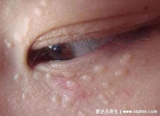 眼部扁平疣圖片及去除方法，不痛不癢有傳染性的粉色疙瘩