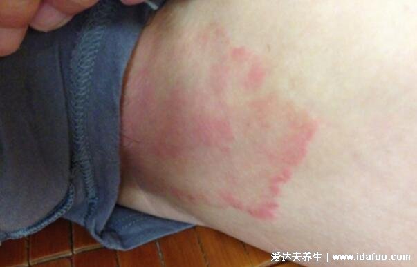 18種常見的皮膚病圖片對照表，濕疹/蕁麻疹/扁平疣/毛囊炎合集