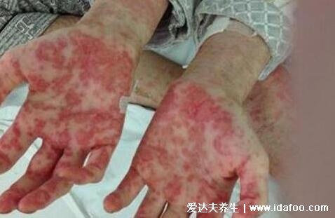 白血病初期針孔小紅點圖片，變瘀斑不癢按壓不褪色(自我檢查法)