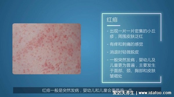 一張圖教你區別濕疹和痱子，從部位/癥狀/時間區分(濕疹時間長)