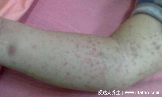 白血病初期針孔小紅點圖片，變瘀斑不癢按壓不褪色(自我檢查法)
