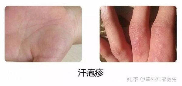 汗皰疹圖片初期癥狀圖片，有水皰干后脫皮有瘙癢灼燒感
