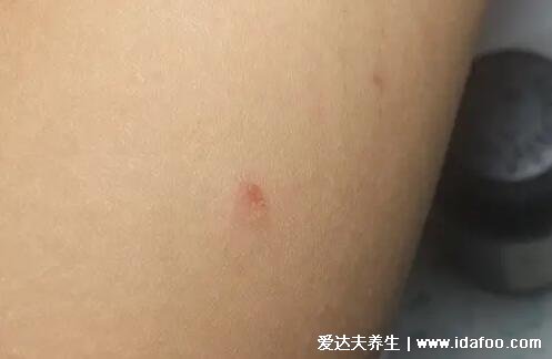 100種癬的種類與辨別圖片，體癬/手癬/頭癬/腳癬/股癬對照圖