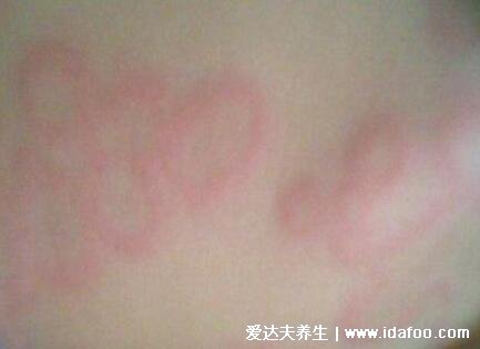 初期麻疹圖片和癥狀圖片，先發熱再出疹從發際開始(按壓褪色)