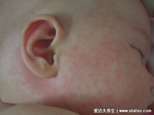 初期麻疹圖片和癥狀圖片，先發熱再出疹從發際開始(按壓褪色)