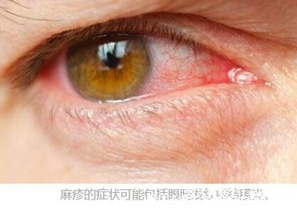 初期麻疹圖片和癥狀圖片，先發熱再出疹從發際開始(按壓褪色)