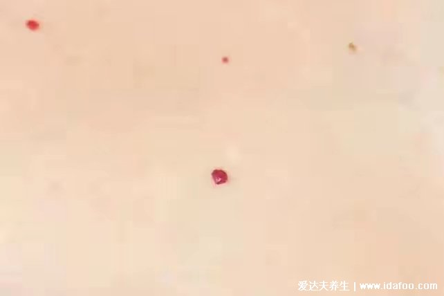 皮膚出現這些“小紅點”時刻反映身體變化。