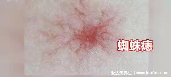皮膚出現這些“小紅點”時刻反映身體變化。