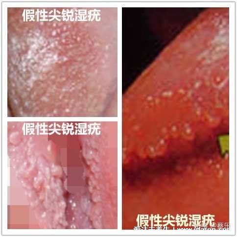 女性假疣和真疣的區別圖片，看看尖濕銳尤典型圖片(真疣可X接觸傳染)