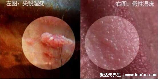 女性假疣和真疣的區別圖片，看看尖濕銳尤典型圖片(真疣可X接觸傳染)