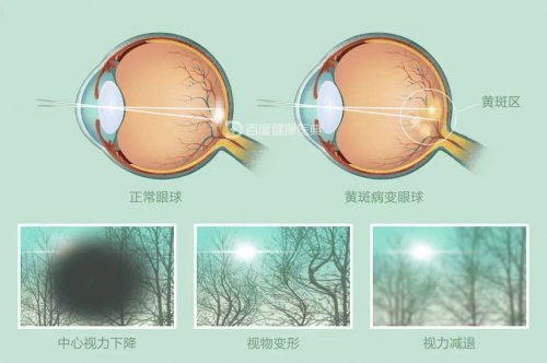 眼部黃斑病變該如何預防